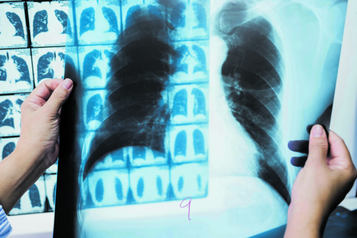 Woman doctor compare patient chest x-ray and CT scan film .Image