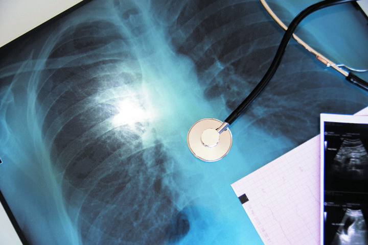 Covid 19 diagnosis with lung x-ray, doctor and stethoscope. Sele
